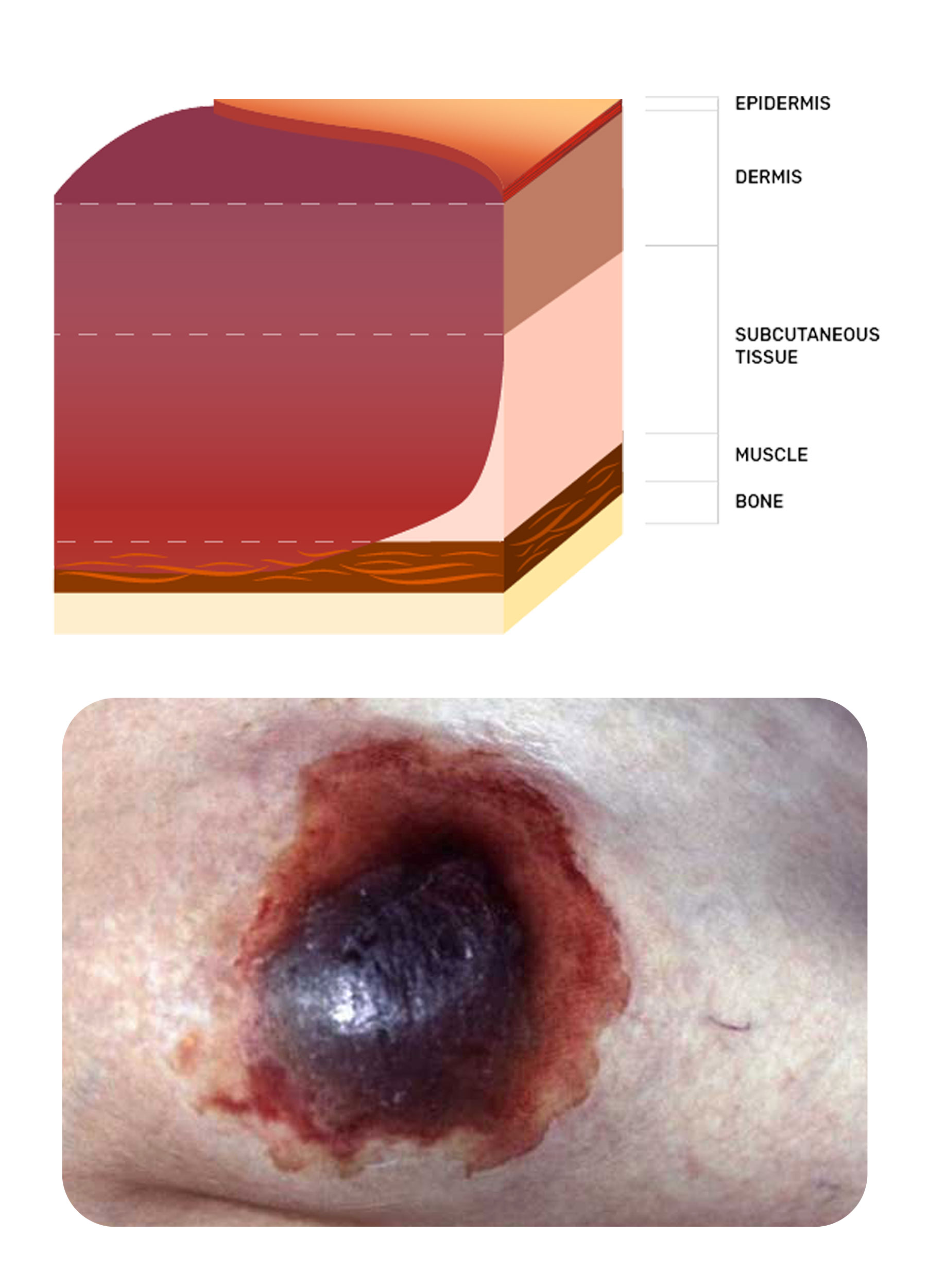 What is an example of a pressure wound?